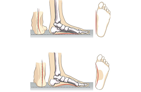 Knee Hyperextension
